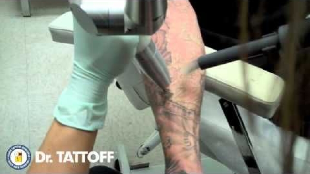 Avoiding Laser Tattoo Removal