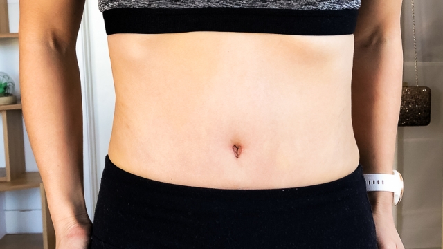 Flatten Your Tummy: Unveiling the Secrets of Abdominoplasty