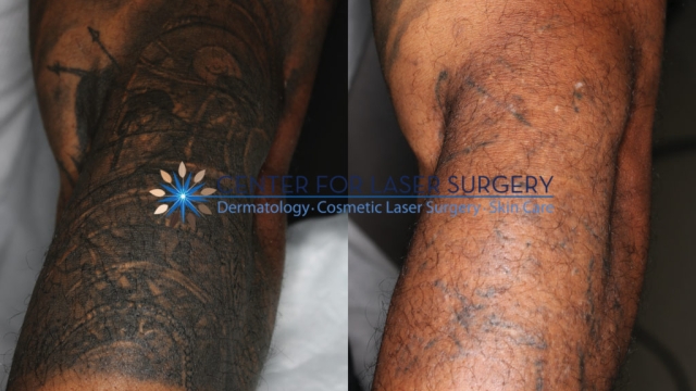The Benefits And Drawbacks Of Laser Tattoo Removal