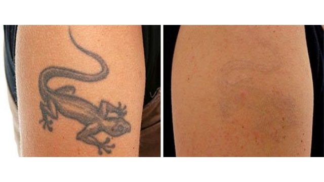 How Much Does Tattoo Removal Amount To? Close Your Wallet And Find Out