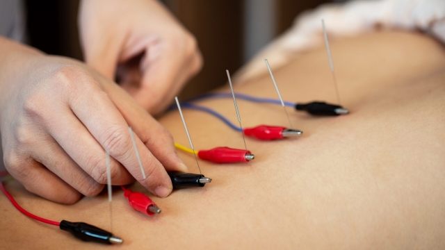 The Healing Power of Acupuncture: Needle Your Way to Wellness